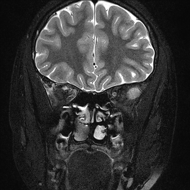 Orbital Lymphangioma Image