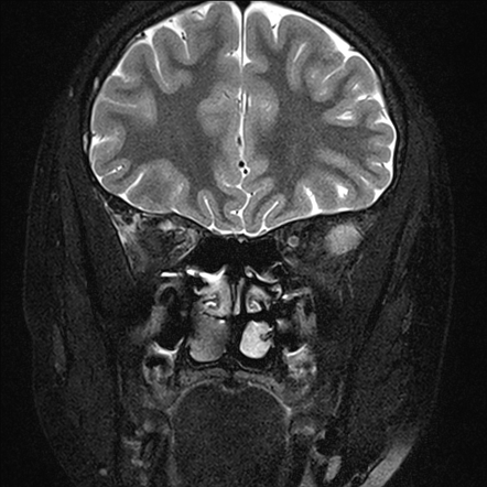 Orbital lymphangioma | Image | Radiopaedia.org