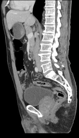 Toothbrush in sigmoid colon | Image | Radiopaedia.org