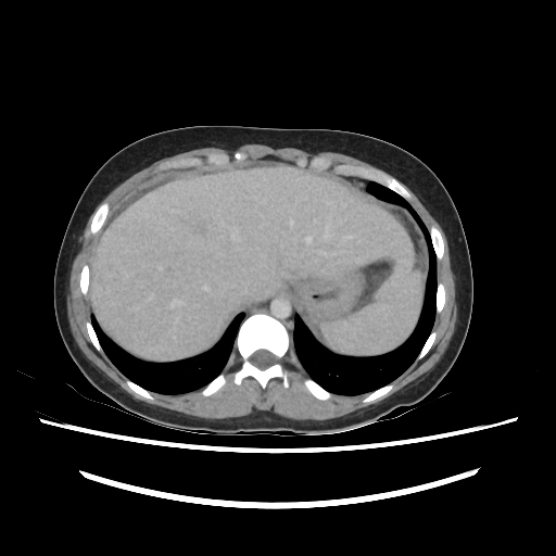 File:Hydatid disease, abdominal dissemination (Radiopaedia 91896-109704 ...