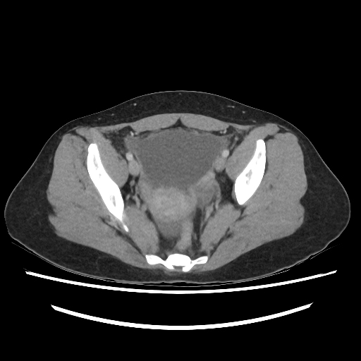 File:Hydatid disease, abdominal dissemination (Radiopaedia 91896-109704 ...