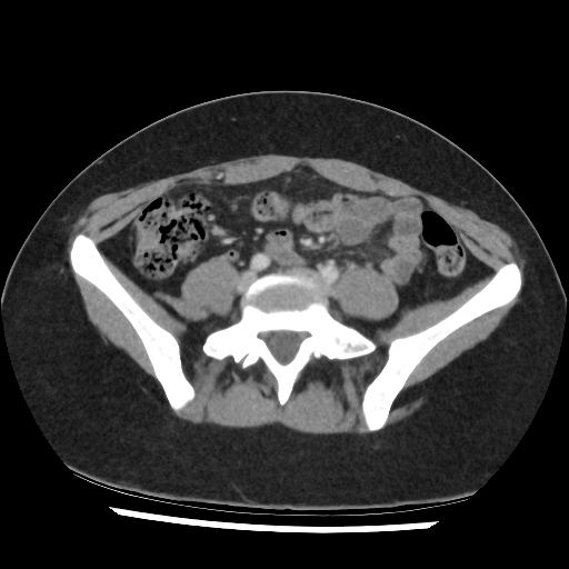 File:Hydatid disease, abdominal dissemination (Radiopaedia 91896-109707 ...