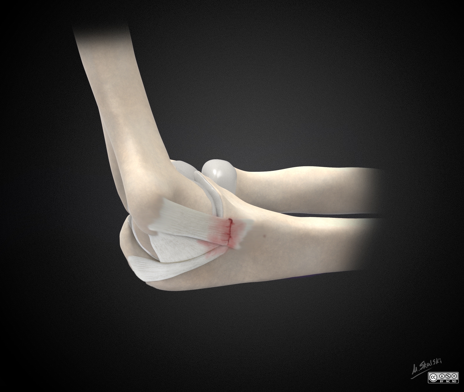 Ulnar Collateral Ligament Tear Illustrations Image Radiopaedia Org