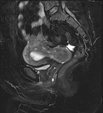 Uterine anteversion associated with a prolapsed submucosal leiomyoma ...