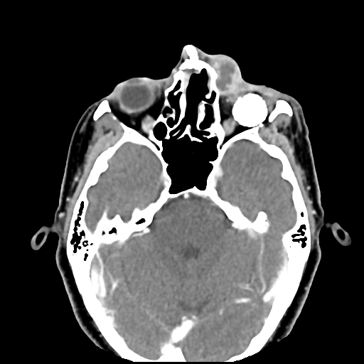 Dacryocystitis | Image | Radiopaedia.org