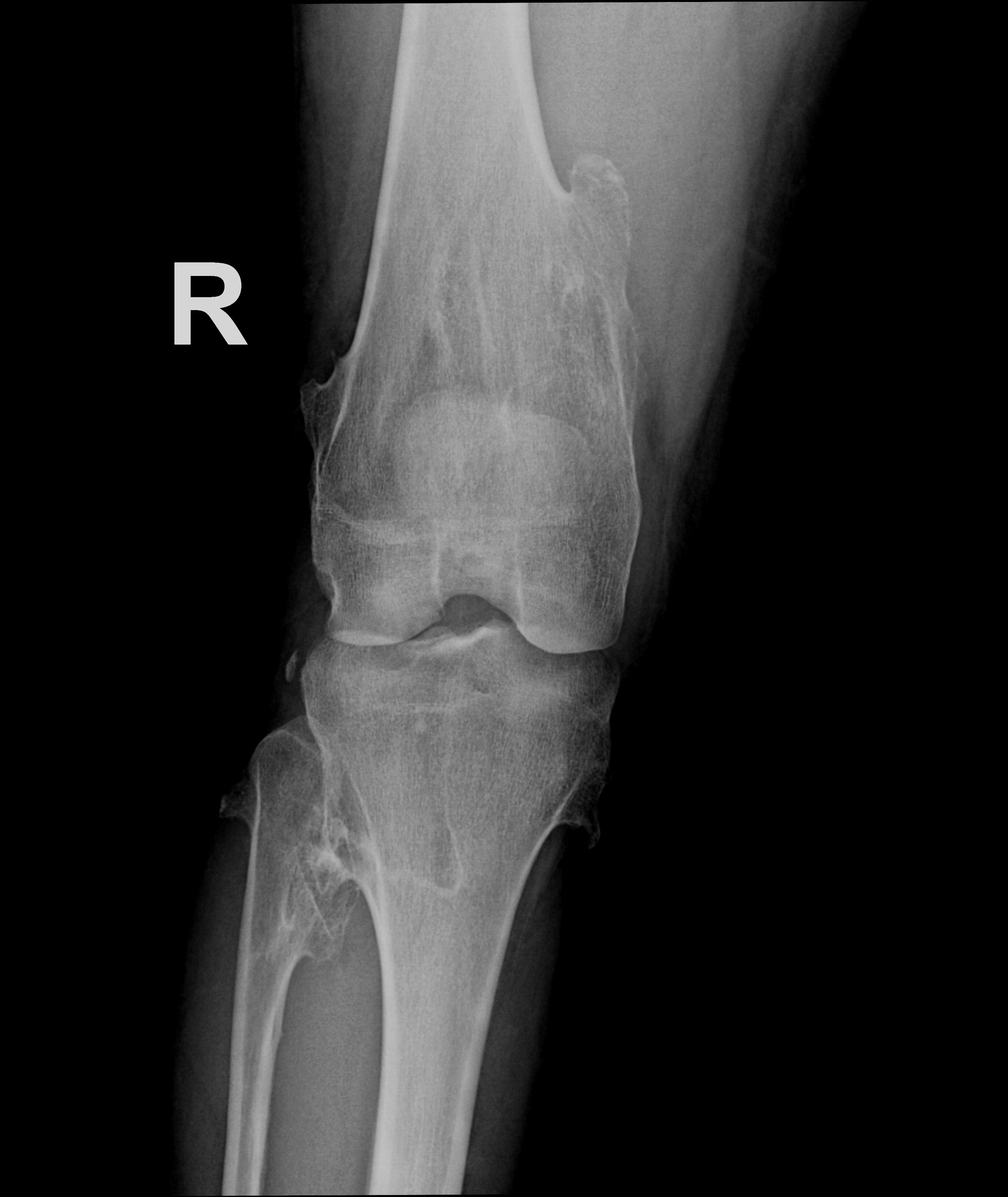 Hereditary multiple exostoses | Image | Radiopaedia.org