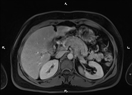 Pancreatic endocrine tumor | Image | Radiopaedia.org