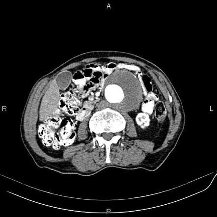 Abdominal Aortic Aneurysm | Radiology Reference Article | Radiopaedia.org