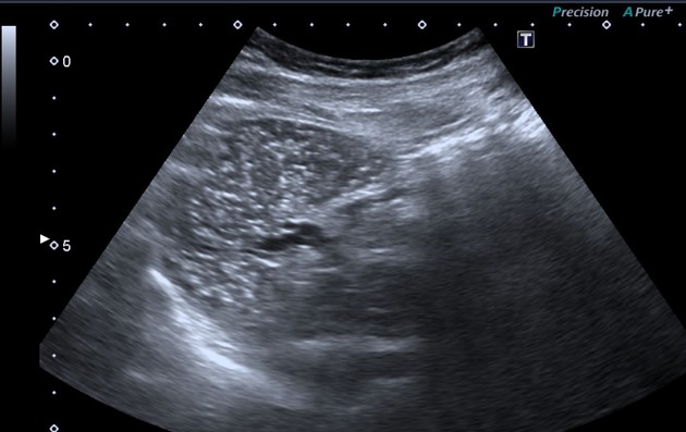 Splenic siderotic nodules | Radiology Reference Article | Radiopaedia.org