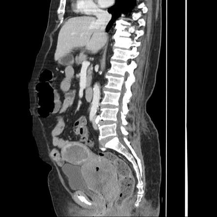 Adenocarcinoma of the cervix | Radiology Case | Radiopaedia.org