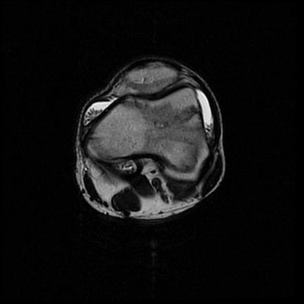 Primary synovial chondromatosis | Radiology Reference Article ...