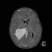 Choroid plexus papilloma | Radiology Reference Article | Radiopaedia.org