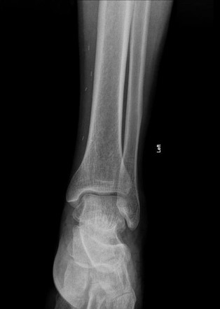 Calcaneal fracture | Image | Radiopaedia.org