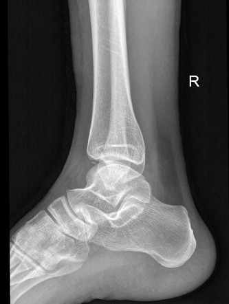 Distal tibial avulsed fracture | Image | Radiopaedia.org