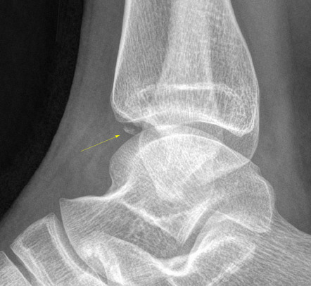 Comminuted tib fib fracture nondisplaced - tasteeditor