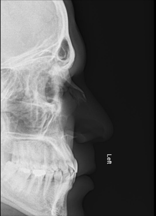 Nasal bone fracture | Radiology Reference Article | Radiopaedia.org