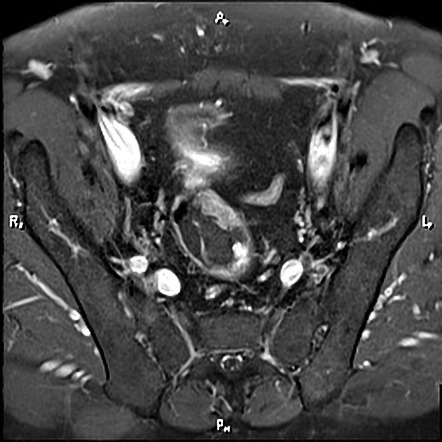 Rectal Cancer | Radiology Reference Article | Radiopaedia.org