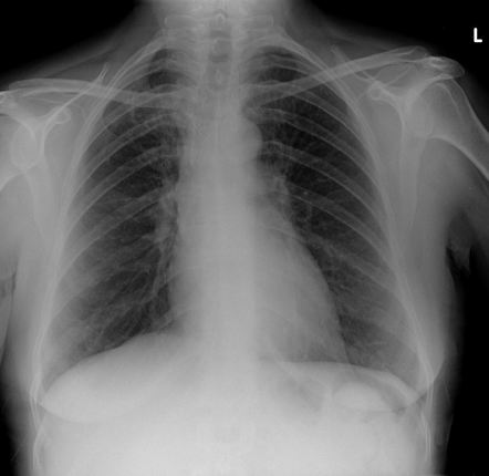 Tracheal stent | Radiology Case | Radiopaedia.org