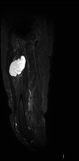 Low Grade Fibromyxoid Sarcoma Image 4527