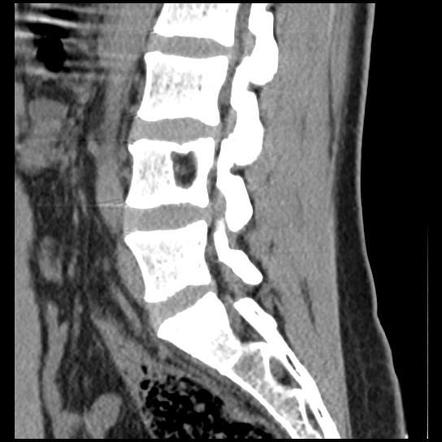 Schmorl nodes | Radiology Reference Article | Radiopaedia.org