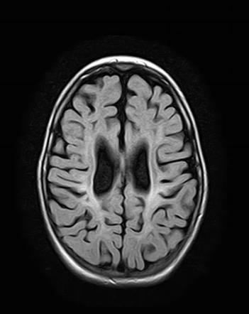 Hypoxic-ischemic encephalopathy - chronic stage | Radiology Case ...