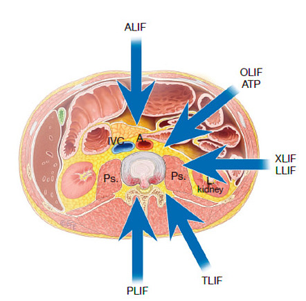 Lumbar interbody fusion (overview) | Radiology Reference Article ...