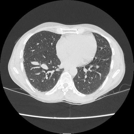 Pulmonary arteriovenous malformation | Radiology Case | Radiopaedia.org