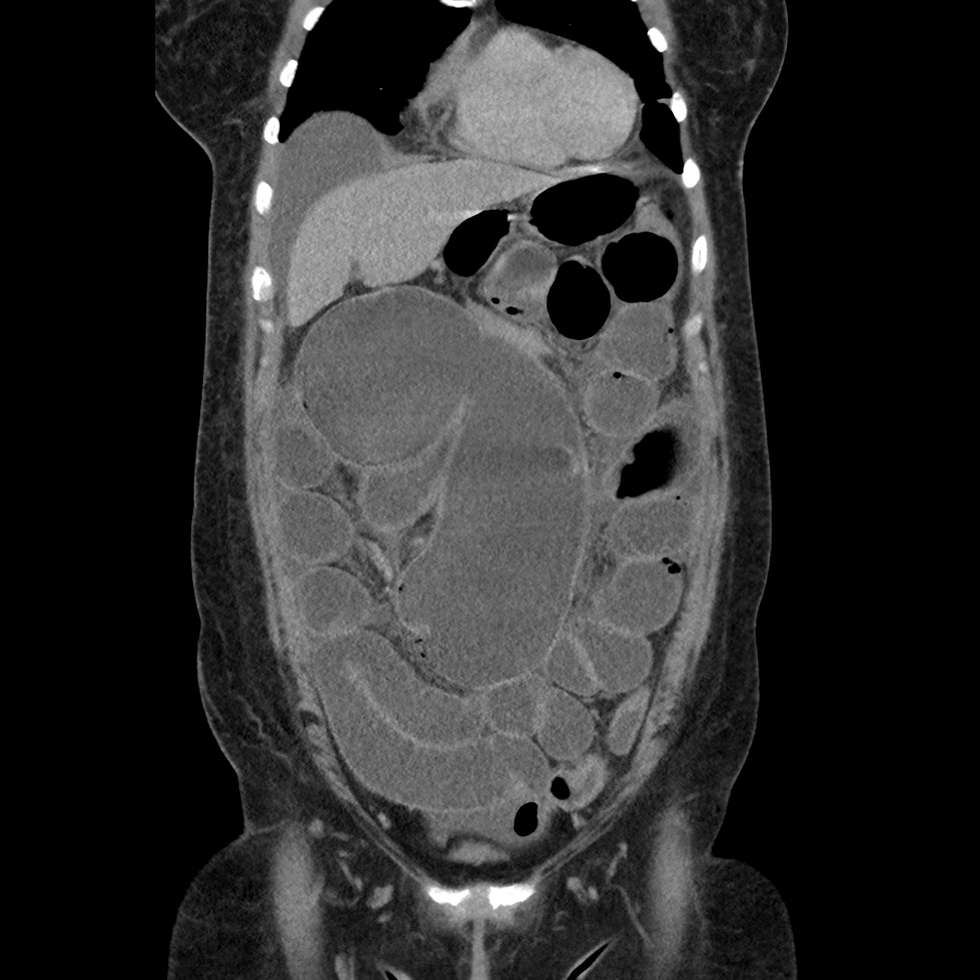 Cecal volvulus | Image | Radiopaedia.org