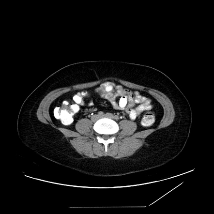 Flash Filling Hepatic Hemangioma Image Radiopaedia Org   9c27d7ec4a08b3e96a5ebfe1fb16270711395109d9e2e061c8641728f7dec757 Gallery 