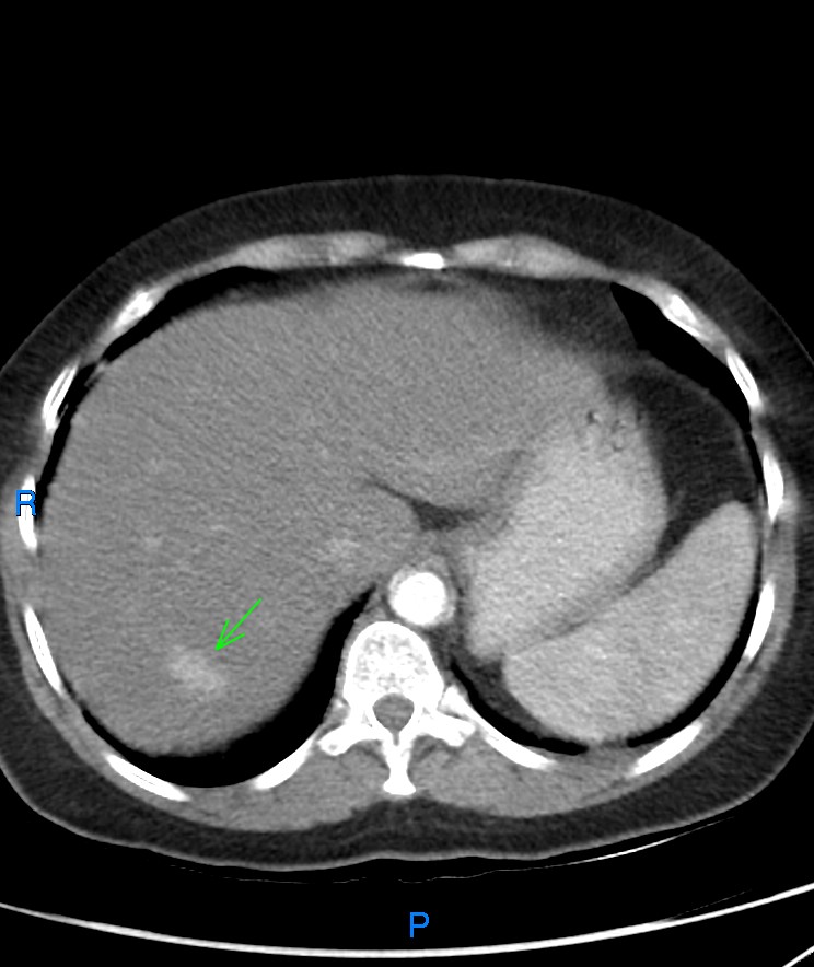 Flash Filling Hepatic Hemangioma Image Radiopaedia Org   0. 