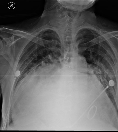 Huge cardiomegaly | Radiology Case | Radiopaedia.org