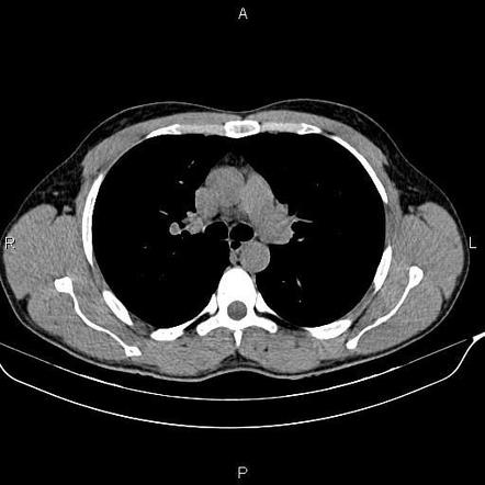 Bifid rib | Image | Radiopaedia.org