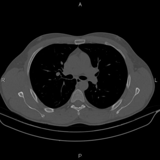 Bifid rib | Image | Radiopaedia.org