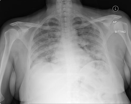 Tension pneumothorax | Radiology Case | Radiopaedia.org