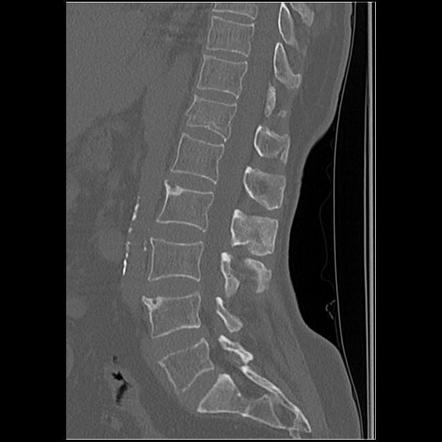 Vertebral fracture - ankylosing spondylitis | Radiology Case ...