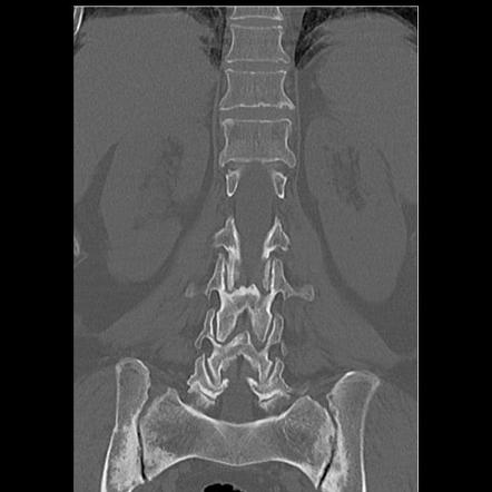 Vertebral fracture - ankylosing spondylitis | Image | Radiopaedia.org