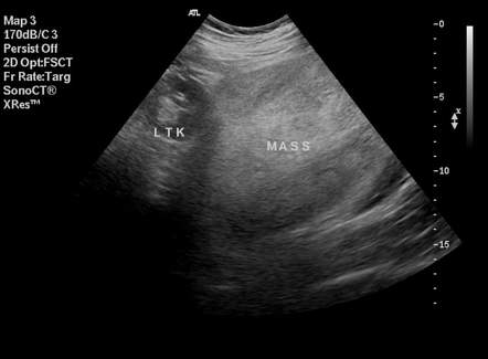 Retroperitoneal liposarcoma | Radiology Reference Article | Radiopaedia.org