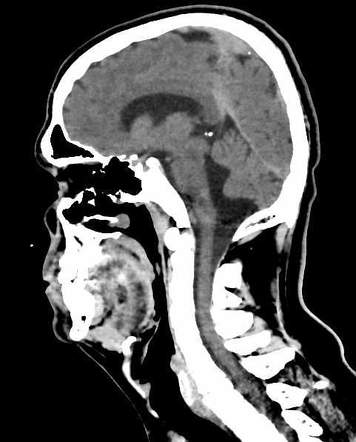 Blake's pouch cyst | Radiology Case | Radiopaedia.org