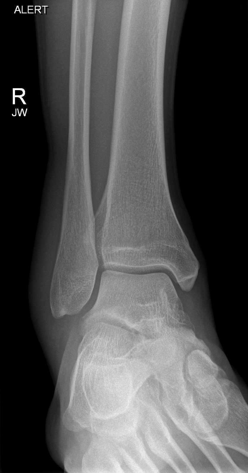 Anterior process of calcaneum fracture | Image | Radiopaedia.org