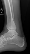 Anterior calcaneal process fracture | Radiology Reference Article ...