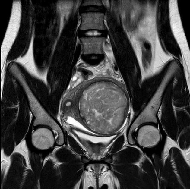 Red Degeneration Of A Leiomyoma | Radiology Reference Article ...