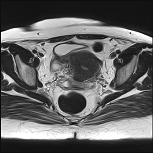 Diffuse uterine adenomyosis with ovarian and subperitoneal ...