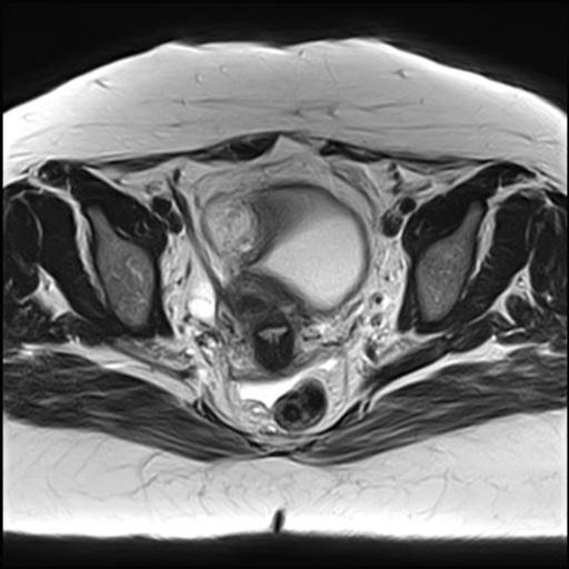 Ovarian Dermoid Cyst Image