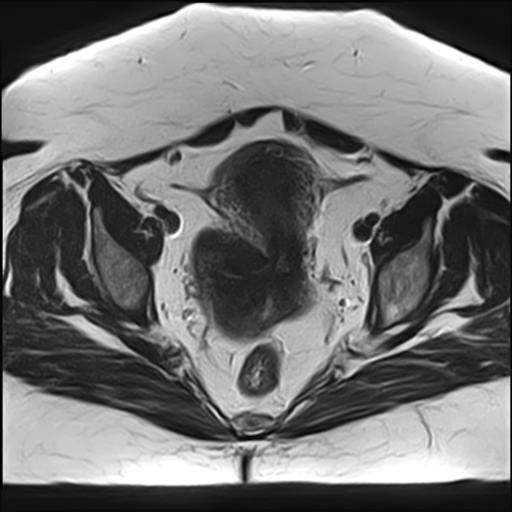 Subserosal uterine leiomyoma | Image | Radiopaedia.org