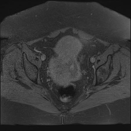 Subserosal uterine leiomyoma | Image | Radiopaedia.org