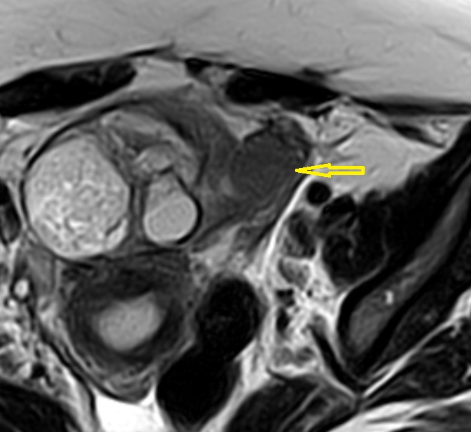 Ovarian Dermoid Cyst Image 