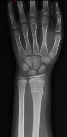 Torus fracture - radius | Radiology Case | Radiopaedia.org