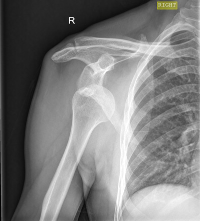 Anterior shoulder dislocation | Radiology Case | Radiopaedia.org