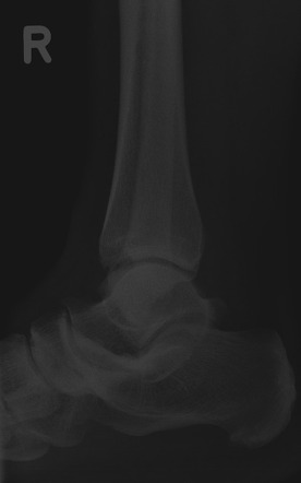 Calcaneonavicular Coalition Bilateral Osseous Radiology Case Radiopaedia Org