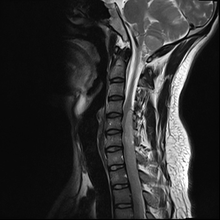 Multiple ependymomas | Image | Radiopaedia.org